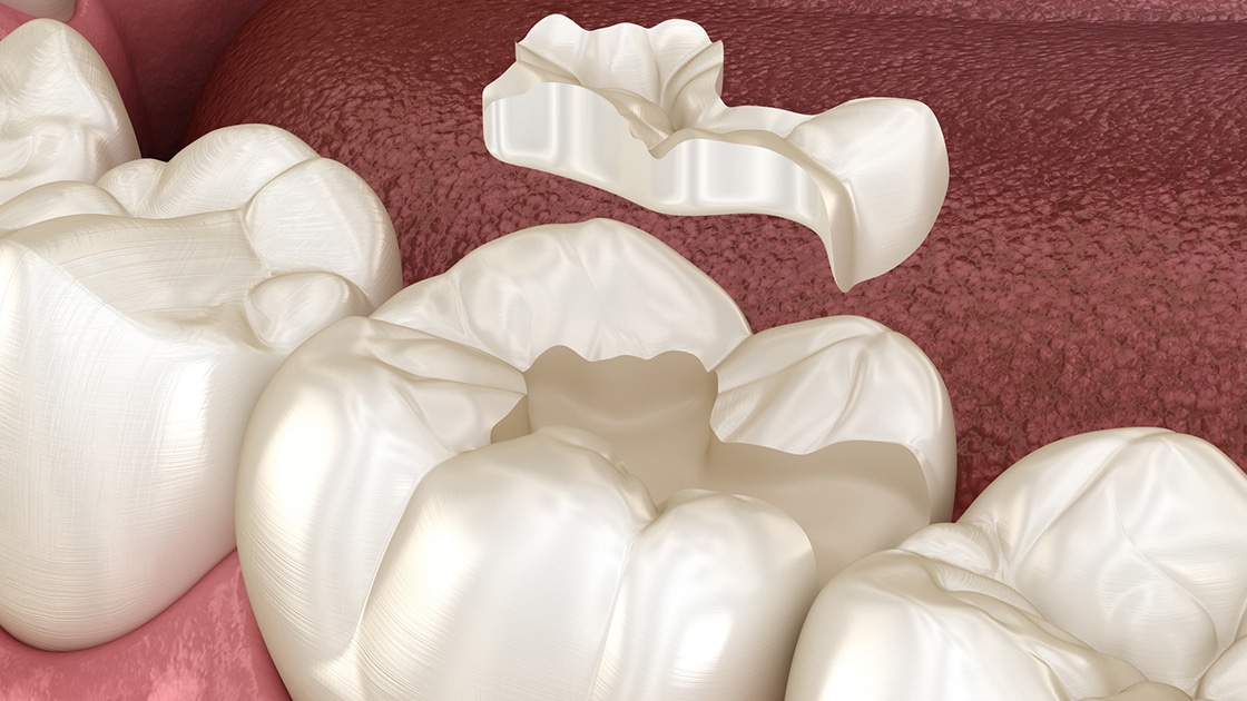 Dental Inlay Photo