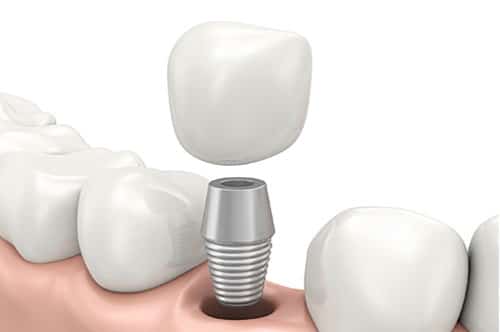 Dental Implants 1.jpg