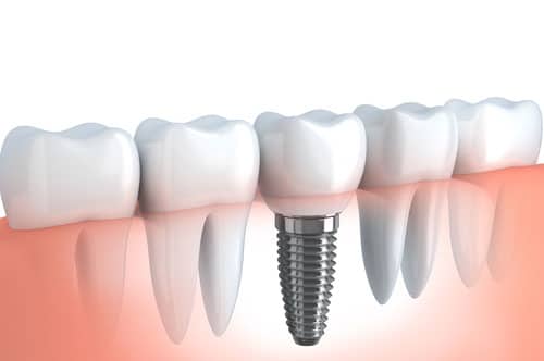 Dental Implants 2.jpg