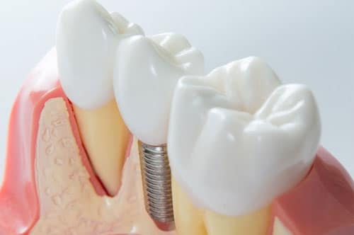 Dental Implants 3.jpg